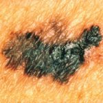 Have your family medical doctor check for melanoma