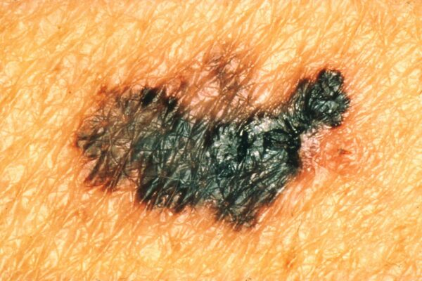 Have your family medical doctor check for melanoma