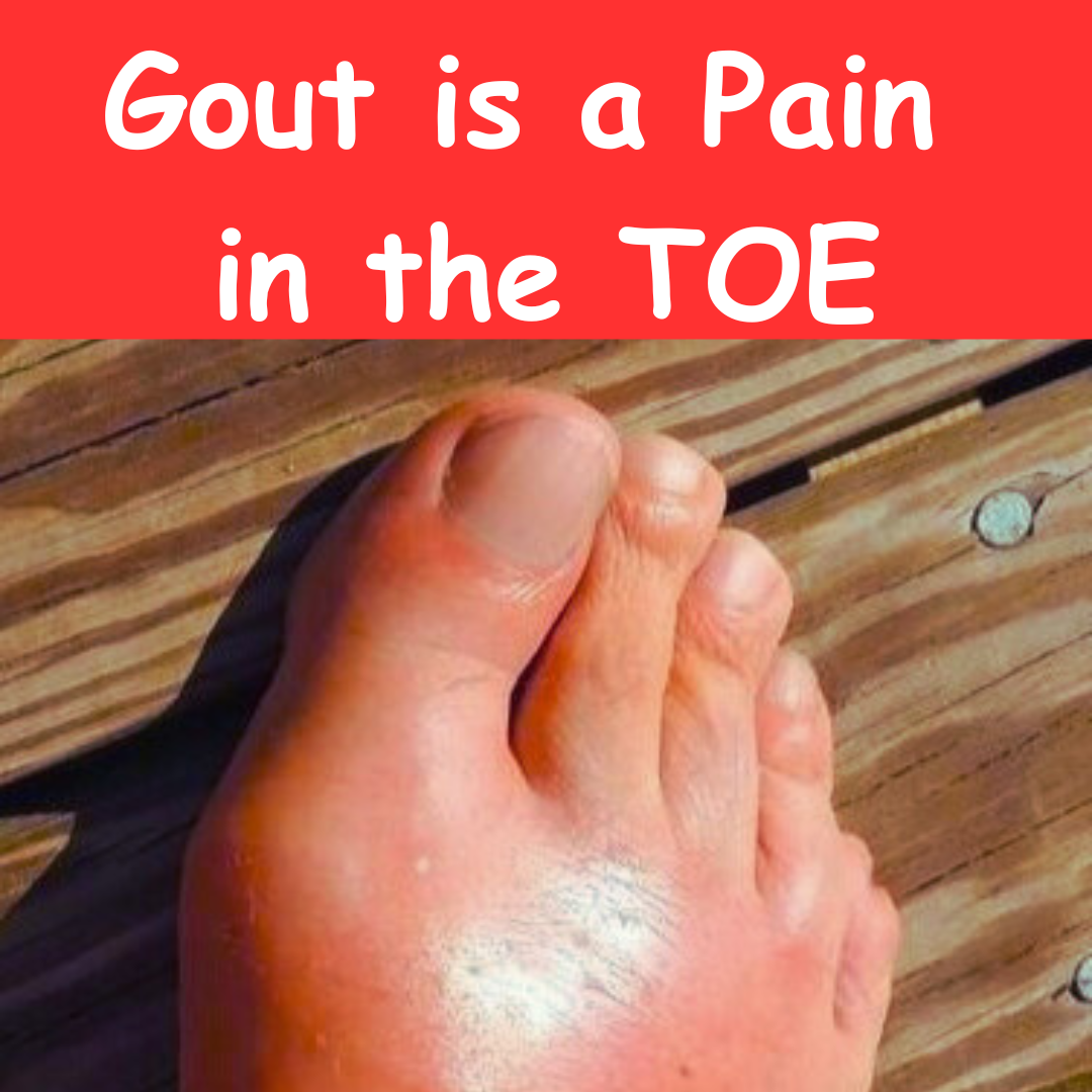 Gout is a Pain in the Toe