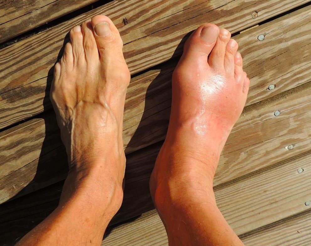 see your family doctor for swelling feet with gout