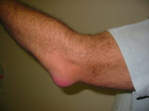 bursitis example