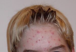 can I get rid of acne? - acne treatment Sacramento