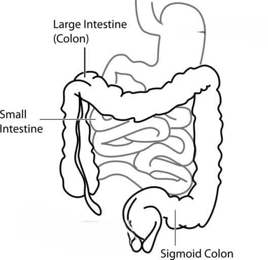 Diverticulosis develops in the Large Intestine